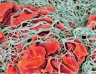 تشکیل لخته خونی